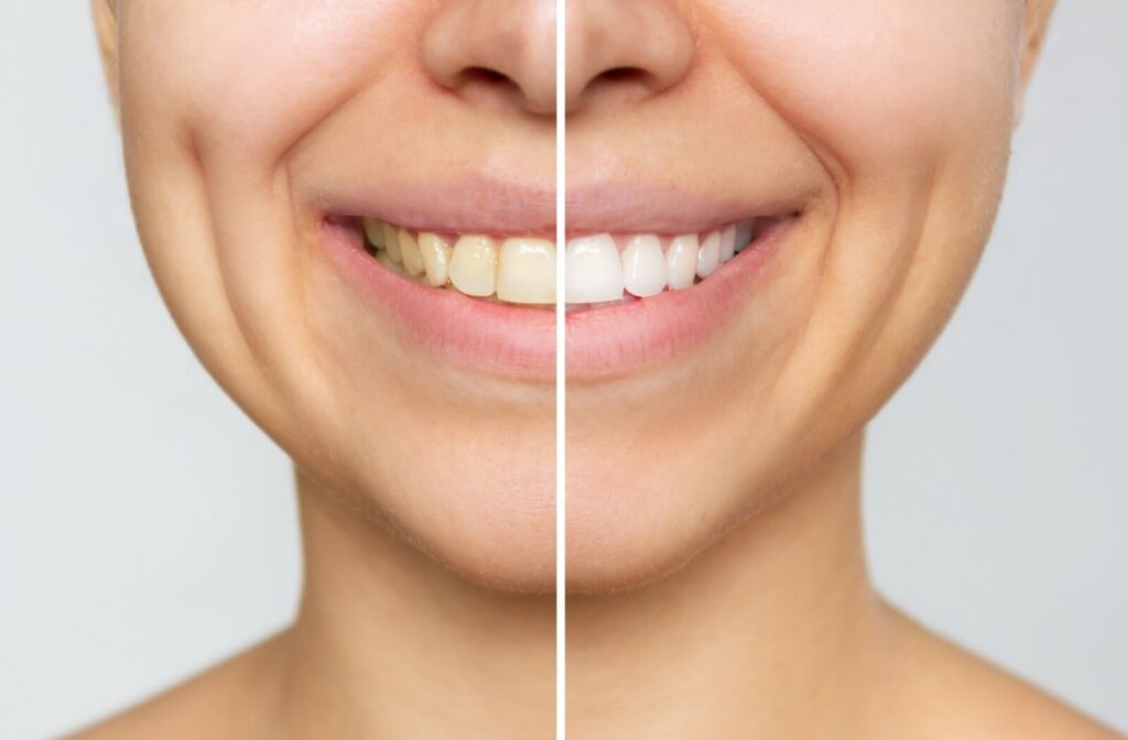 A close-up image of a woman's face split to show the before and after results of teeth whitening.